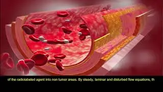Blood Flow and Arterial Infusion by Implanted Port in In-111 Octreotide Therapy: Critical Overview
