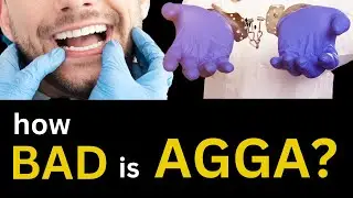 What the AGGA Issue Means for Patients & Dentists | Anterior Growth Guidance Appliance Controversy