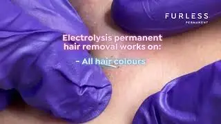 How to Permanently Remove PCOS & Hormonal Hair Growth | Permanent Solution