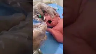 Suction process of newborn  for nose and mouth clean  bad water