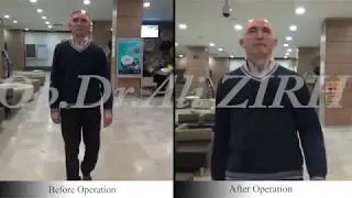 Hacı Yusuf KOCA / Before and After Surgery Parkinson's Treatment DBS in Turkey