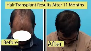 ✅Hair Transplant Result before and After 8 Months | 5000 Grafts | Best Hair Transplant in Delhi