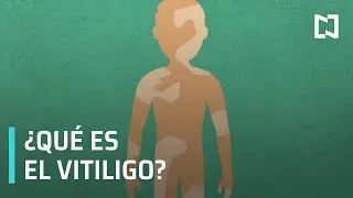 &iquest;Qu&eacute; es el vit&iacute;ligo? - Noticias MX