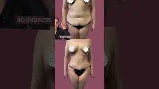 TUMMY TUCK RESULTS🤩 | Saber Plastic Surgery #tummytucksurgery #tummytuckresults #plasticsurgeon