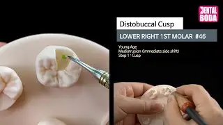 Lower Right 1st Molar distobuccal cusp 1 cusp (young-aged) Wax-Up #46-1