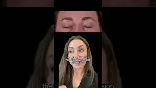 Upper eyelid incision: barely seen at 6 months
