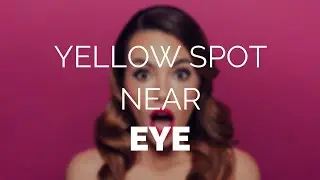 Yellow spot near eye, what is it and how do you remove it?
