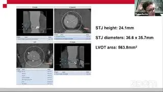 Curso Sapien 3 (Aula 3)- Passo a passo do implante de TAVI - Dr. Thales Rocha