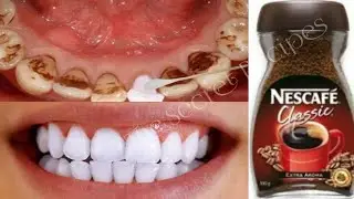 Magical Teeth Whitening remedy||Whiten your yellow teeth naturally||Remove tartar/The Secret Recipes