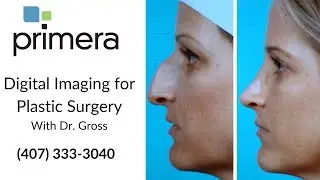 Benefits of Digital Imaging for Plastic Surgery | Dr. Gross