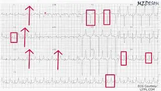 PRACTICE ECG 6