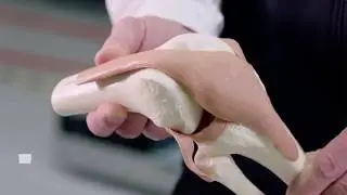 Understanding knees and implants