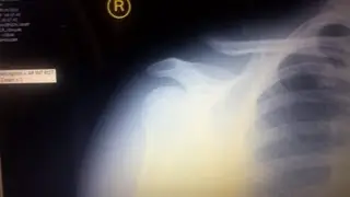 Grade 3-5 AC Separation, 8 weeks post injury