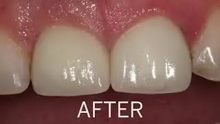 Dental Implants San Jose & Campbell CA | Implant Tooth | Replace Missing Teeth