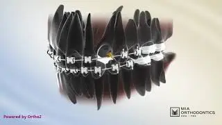 How Impacted Teeth Are Treated: Surgical Exposure and Orthodontic Eruption