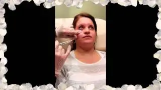 Botox and tear trough lower eyelid filler at Accents Cosmetic Surgery and Medical Spa in Michigan