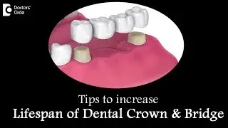 How to care for a crown and bridge? How long does it last? - Dr. Ranjani Rao