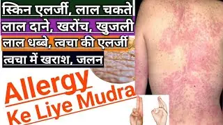 Sharir Par Lal Chakte Hona | Allergy Ke Liye Mudra | Khujli Aur Lal Dane Ka Ilaj