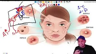 Acne | Master The OPD Demo Lecture | Dr S.M Huzaifa