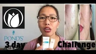 Ponds Acne Clear Review | Ponds 3 day challenge | Philippines