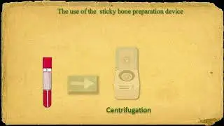 Sticky bone clip