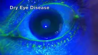 Dry Eye Disease