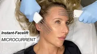 Neurotris Microcurrent Instant Facelift at Ruth Swissa Med Spa