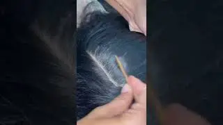 #fypviralシ #statisfying #Lice #hair #LiceOnHead #liceremoval #brasil #xyzbcafyp #licepopping #kutu