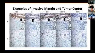 11. PROGNOSTIC IMPACT AND UTILITY OF IMMUNOPROFILING IN THE SELECTION OF PATIENTS WITH COLORECTAL