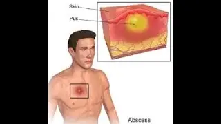 What is an Abscess ; Definition, Characteristics, Types, Treatment