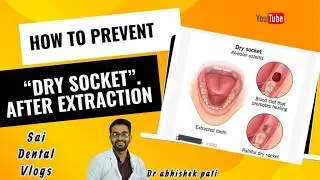 HOW TO PREVENT DRY SOCKET AFTER EXTRACTION