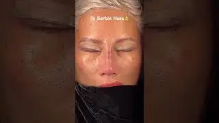 Asian Rhinoplasty Turkey I Ethnic Nose Job I Op.Dr.Harun Acıpayam