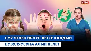 Суу чечек менен ооруган балага зелёнка жардам береби? | 