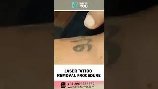 Say Goodbye to Permanent Tattoo with Laser | Laser Tattoo Removal in Delhi | Dr. PK Talwar