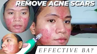 DERMA PEN FOR ACNE SCARS AND PIMPLE MARKS | MICRONEEDLING | My First Session