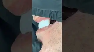 Checking the Emergence Profile #dental #teeth #smile #lsk121shorts #shortvideo #shorts #patient