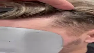 Invisible Hairline | Mimics The Natural Growth Pattern of Hair | Lavivid Hair System