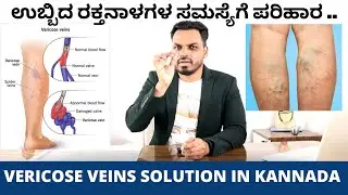 ಕಾಲಿನಲ್ಲಿ VERICOSE VEINS ಸಮಸ್ಯೆಗೆ  ನೈಸರ್ಗಿಕ ಪರಿಹಾರ | 3 TIPS FOR VERICOSE VEINS | IN KANNADA
