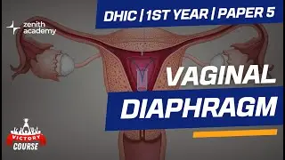 Vaginal Diaphragm (DHIC 1st yr | Paper 5) | Zenith Academy | Victory Course