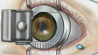 PreOp&reg; LASIK Laser Eye Surgery