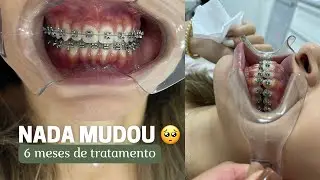 6 MESES DE APARELHO AUTOLIGADO