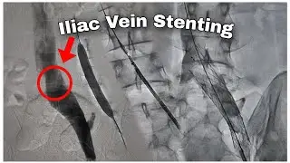 Iliac Vein Stenting 🫀 | Cath Lab | DSA | ROAD MAP | PERIPHERAL 