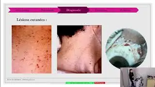 Embolie graisseuse par le Dr Julie Arnauld