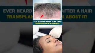 What is Tenting After Hair Transplant? Causes & Solutions | Dr Anand Hair & Skin