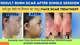 Result Burn Scar after Single Session | जले हुए चेहरे पर रिजल्ट का जादू | Face Scar Treatment