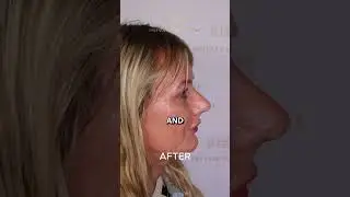 3 Months After Rhinoplasty | Thick Skin Nose Transformation by Dr. Arshad