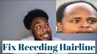 Fix your Receding Hairline