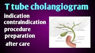।।T tube cholangiogram।।x ray procedure t tube cholangiogram।cholicestectomy।contrast media