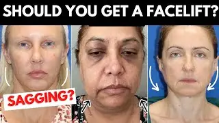 What's The Right Age to Get a Facelift? Your Questions Answered!!