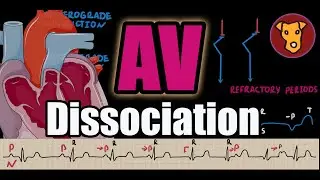 AV Dissociation EXPLAINED: Classification, Pathophysiology & ECG Criteria (Beginner&rsquo;s Guide)